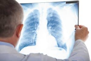 Can a Car Accident Cause a Pulmonary Embolism?